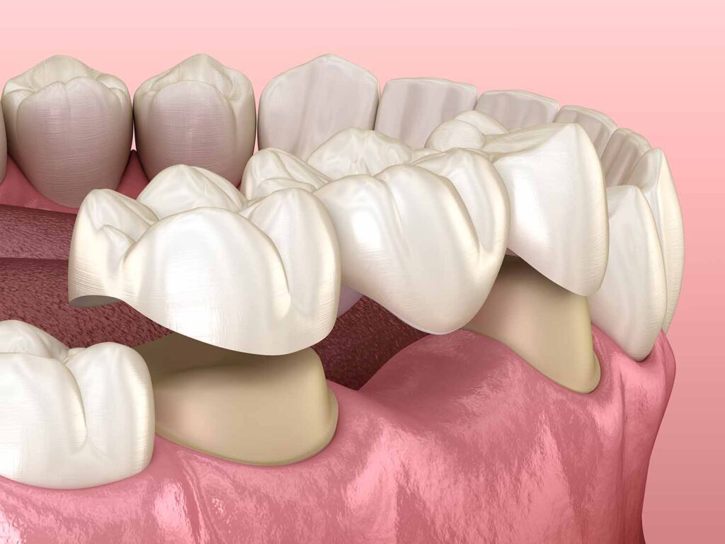 Dental three- unit bridge , the image shows difference between Three-Unit Bridge and implants