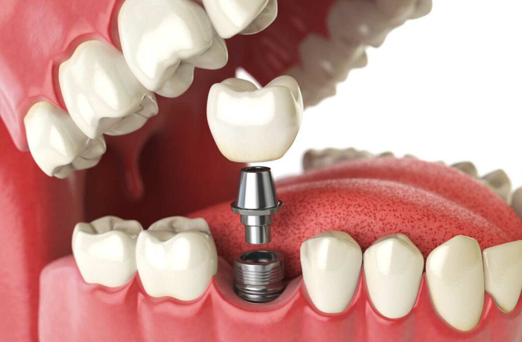How is a Crown Attached to a Dental Implant?