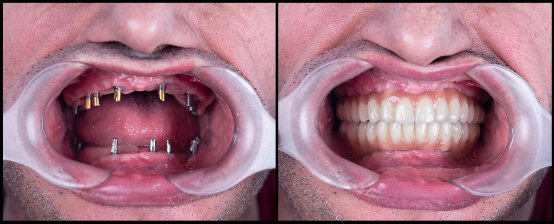 screw treatment for teeth