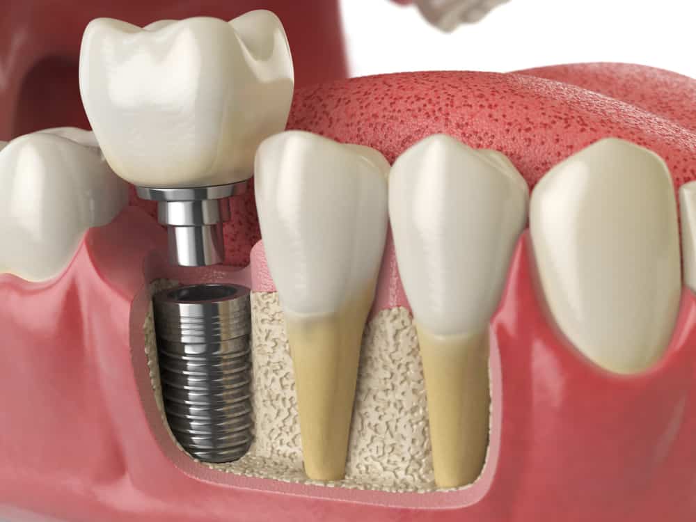 Is dental Implant safe for health?
