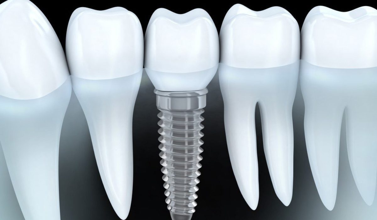 Oral screw teeth implant