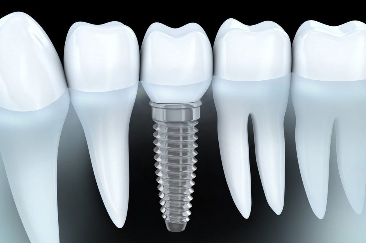 Oral screw teeth implant