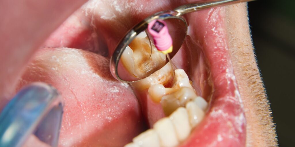 Understanding the Anatomy of a Tooth