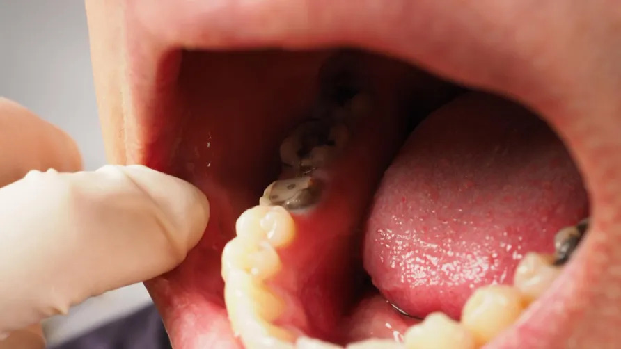 cavities causing bad breath